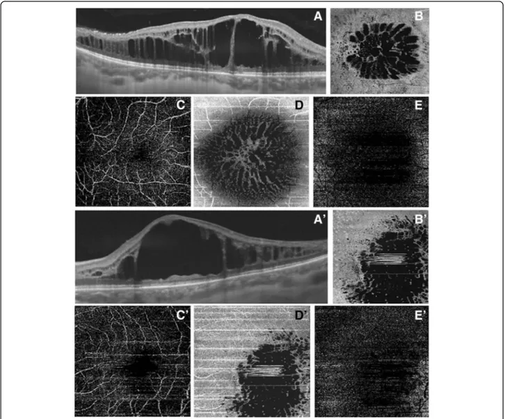 Fig. 3 Swept source optical coherence tomography and optical coherence tomography angiography in right eye (a) and left eye (a ’) affected by enhanced S-cone syndrome