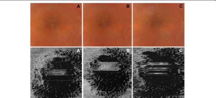 Fig. 6 Fundus photography and “en face” optical coherence tomography images of the left eye showing the progression of macular schisis.