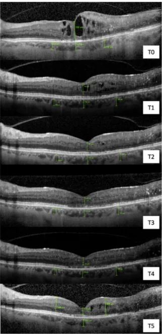 Fig. 3 Example of an enhanced-depth image-optical coherence tomography (EDI-OCT) of a diabetic macular oedema eye in a patient (#5) who underwent an intravitreal injection of long-release dexamethasone 700 lg at baseline (T0)