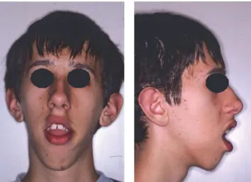 Figure 1: Front and lateral photographs of the patient at the time of the first visit.