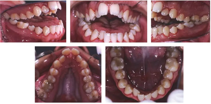 Figure 2: Intraoral photographs at the time of the first visit.