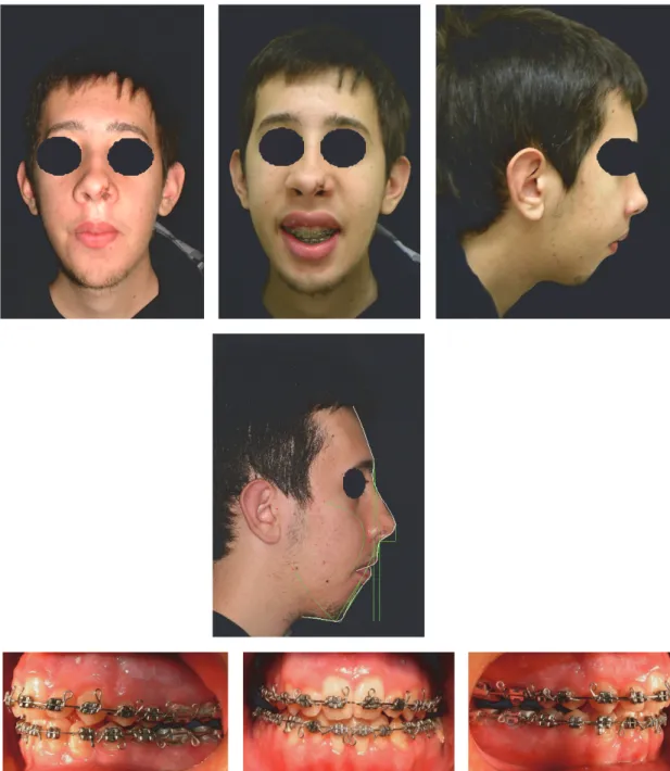 Figure 6: Extraoral and intraoral photographs and Arnett-Bergman soft tissues analysis after surgery.
