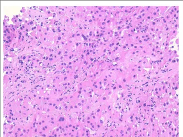 FIGURE 1 | Proliferation of large atypical cells with abundant eosinophilic cytoplasm organized in nests and ribbons (hematoxylin–eosin).