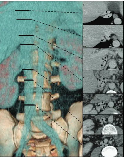 Figure 1: Levels at which IVC was evaluated. The seven levels at which IVC was evaluated are reported on a 3D Volume Rendering reconstruction and the corresponding axial images are shown