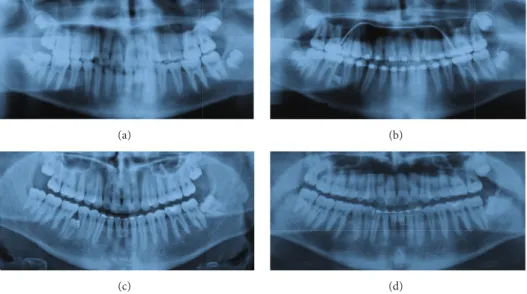 Figure 1: Case 1 radiography: before treatment 2004 (a), before rebonding, ST in 4.5–4.6 region, 2006 (b), 5 years after debonding 2011 (c), and after the extraction of the ST 2013 (d).