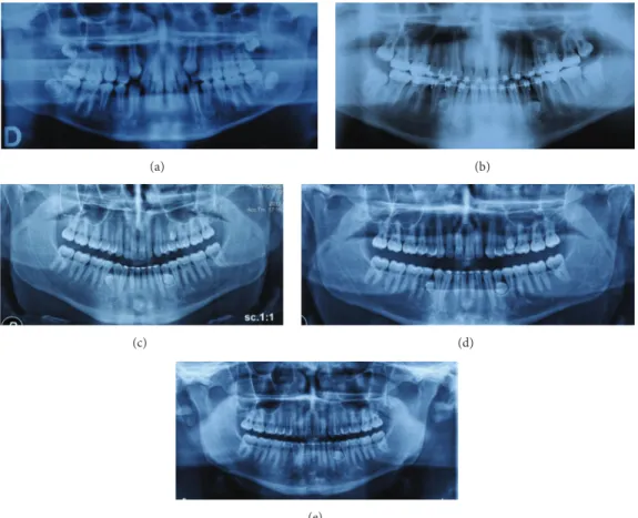 Figure 2: Case 2 radiography: before treatment 2006 (a), before rebonding, ST in regions 3.4–3.5, 4.4–4.5, and 2.5–2.6, 2009 (b), 3 years after debonding 2012 (c), 4 years after debonding 2013 (d), and after the extractions of ST in regions 4.4–4.5 and 2.5
