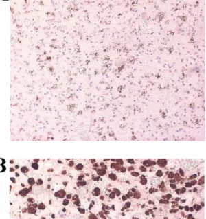Figure 8 Microglia cells in human glioblastoma tissue