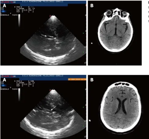 Figure 4  Lateral ventricles. A: Lateral ventricles in echography. Frontal horns of lateral ventricles are visualized as hypoechogenic structure, well visible between two  parallel lines corresponding to the medial and lateral layer of the ependima