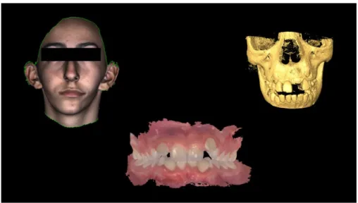 Figure  1.  The  three‐dimensional  workflow  (from  left  to  right):  3D  image  of  the  face,  intraoral  impression of the dentition and cone‐beam computed tomography (CBCT) scan of the skeleton. 