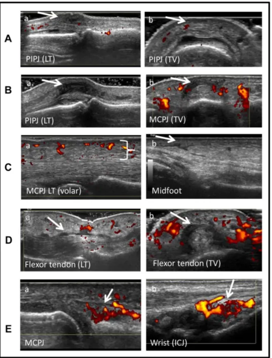 Figure 2  Ultrasound findings in flares of palindromic rheumatism. Representative images of the different types of ultrasound pathology detected  at the flaring region are shown in the panels