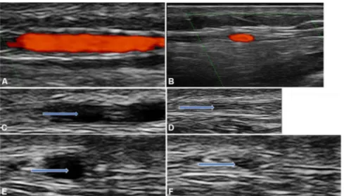 Figure 1  Normal temporal artery branch: (A) longitudinal view; (B) transverse view; (C) longitudinal view before compression; 