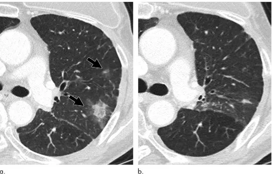 Figure 8:   Images show osimertinib-related transient asymptomatic pulmonary opacities in a 65-year-old woman with  lung adenocarcinoma