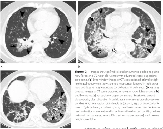 Figure 2:  Images show gefitinib-related pneumonitis leading to pulmo- pulmo-nary fibrosis in a 72-year-old woman with advanced-stage lung  adeno-carcinoma