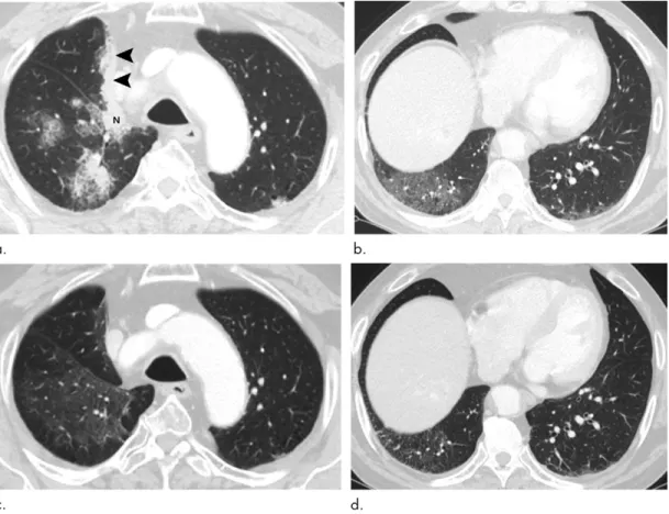 Figure 3:  Images show pembrolizumab-related pneumonitis with organizing pneumonia pattern in a 68-year-old man with lung ad- ad-enocarcinoma