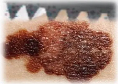 Figure 7. Microneedles toward melanoma. 