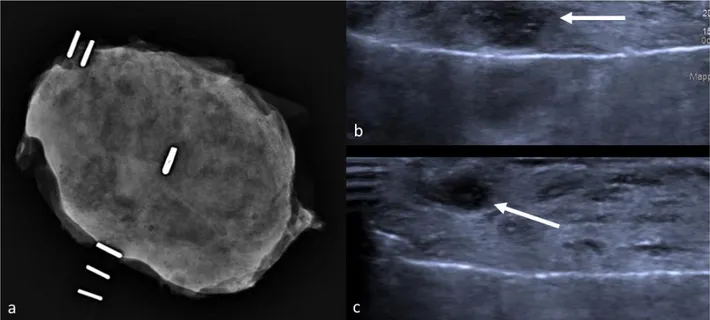 Figure 6. Radiograph of a dense, glandular specimen with scarcely recognizable nodules (a)