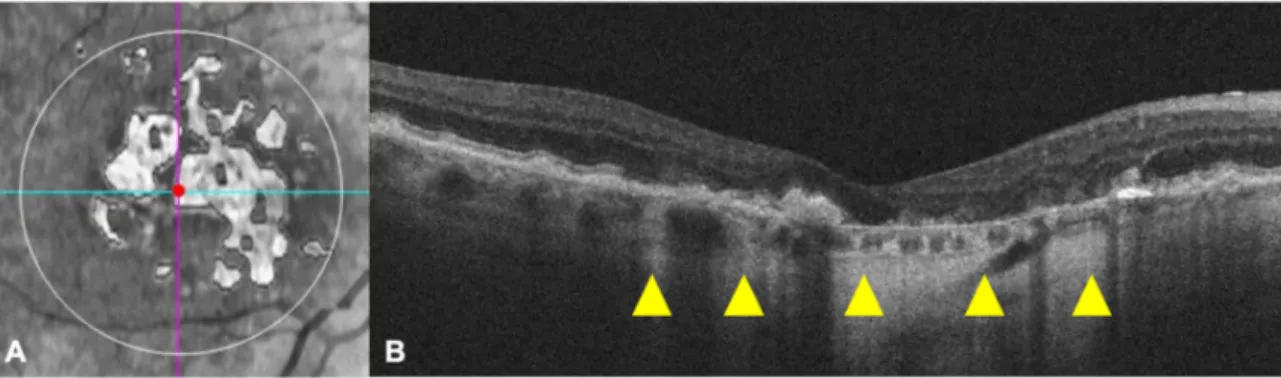 Figure 1. The sub-retinal pigment epithelium (RPE) platform (A), automatically provided by the  Advanced RPE analysis software, shows the sub-RPE illumination (SRI) regions within the circular  area of 5 mm (white outline) around the fovea (centered by the