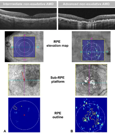 Figure 3. Images of B-scan, retinal pigment epithelium (RPE) elevation map, sub-RPE platform, and  RPE outline of two patients with intermediate (A) and advanced (B) non-exudative age-related  macular degeneration (neAMD)
