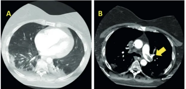 Figure 2. Computed tomography scan imaging of ARDS associated to COVID-19 and pulmonary emboli related to patient  1
