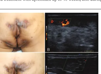 Figure 2. Case 2: (A) Very-severe Hurley III hidradenitis suppurativa (HS-PGA 5/5) with extensive involvement of the inguinal, perineal, perianal, and inner thigh areas