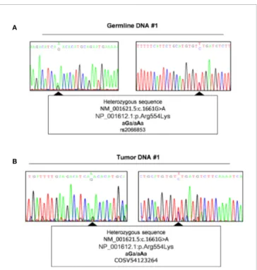 FIGURE 3 | Evaluation of Loss of heterozygosity. Representative sequence analysis of aryl hydrocarbon receptor (AHR) exon 10, surrounding region of polymorphism rs2066853, in germline (A) and tumor DNA (B) of the same patient (#1)