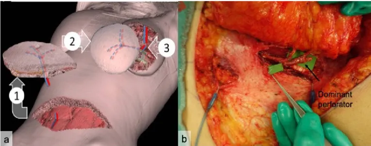 Figure 1. Three-dimensional graphic illustration of a DIEP (deep inferior epigastric perforator) flap procedure (a)