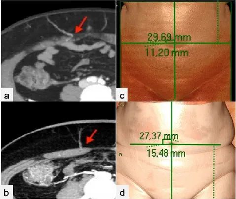 Figure 3. Dominant perforator’s emergence from the anterior rectus abdominis fascia (red arrows)  in cCT (a) and CTa (b) axial sub-volume maximum intensity projection (MIP) reconstructions