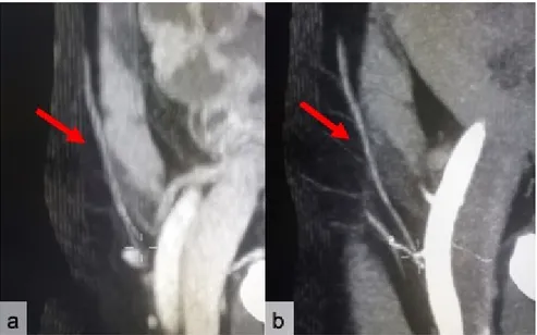 Figure 5. Assessment of the SIEA caliber compared to the dominant perforator. cCT (a) and CTa  (b) sub-volume sagittal MIP reconstructions show a SIEA (red arrows) with a 2 score (equal to the  dominant perforator)