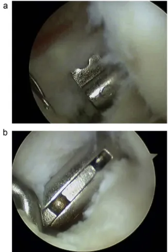 Fig. 1. (a, b) Introduction of guide wires into the femur and tibia with the out-in/free- out-in/free-hand techniques and drilling of the tunnels.