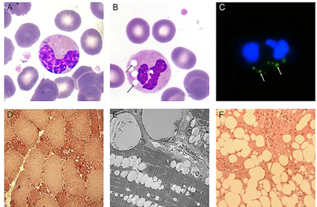 Figure 5. Evaluation  of  abnormal  LDs  in  specific  tissues. Microphotographs of Jordans’ anomaly,  indicated by arrows, in NLSD patient buffy coats stained with May-Grunwald-Giemsa (MGG) (B)  compared to control cells (A) (magnification 100×)