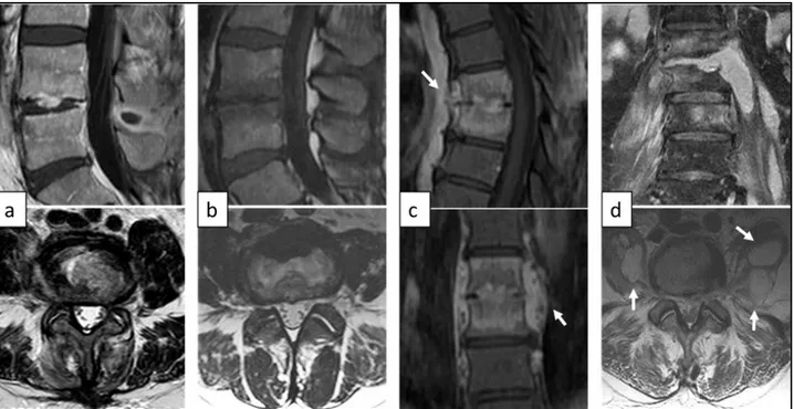 Figure 4 Frequency of most common onset symptoms observed at diagnosis in overall population  Figure 5  Self-reported Visual Analog Scale (VAS) scores are shown at diagnosis and at 1,3,6,12,  and 24 months post-diagnosis