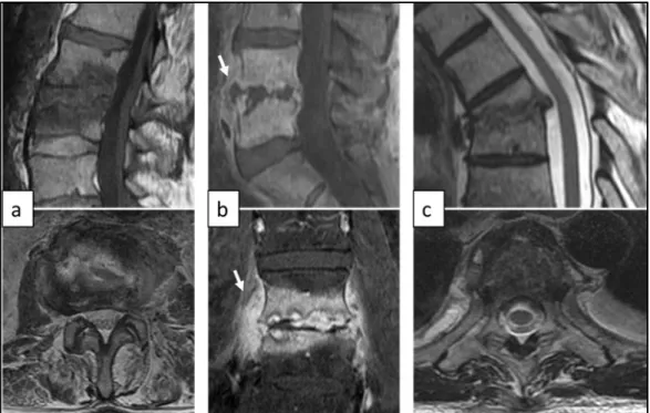 Figure  8  MRI  of  type  B  destructive  pyogenic  spondylodiscitis  (PS).  (a)  Sagittal  T1-weighted  and  axial  T2- T2-weighted MRI showing type B.1 PS with partial destruction of L3 vertebral body