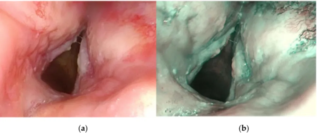 Figure 3. Patient, 65 years old, with history of laryngeal squamous cell carcinoma treated with  chemoradiotherapy