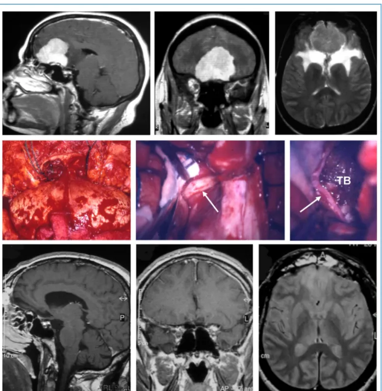 Figure 2. Illustrative case of a medium-sized olfactory groove meningioma (diameter 42 mm)