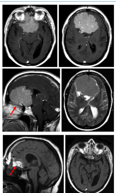 Figure 3. Illustrative case of a large olfactory groove meningioma (diameter 68 mm). Upper and middle panels, preoperative axial and sagittal gadolinium-enhanced T1- and axial T2-weighted MR images showing the tumor with brain edema of low degree