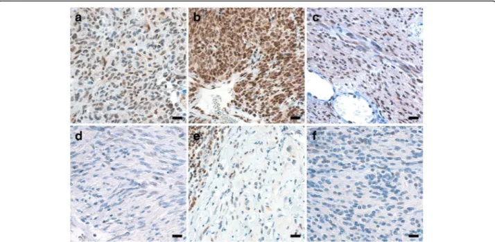 Fig. 2 MGMT protein expression assessed by IHC in six examples of GIST. At MGMT IHC, MGMT-unmethylated GISTs 43 (a), 26 (b), and 27 (c) featured nuclear staining in the majority of cells (score 3), unlike MGMT-methylated GISTs 32 (d), 31 (e), and 44 (f) (s