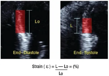 Figure 3. Longitudinal  Strain of  the Left Ventricle 