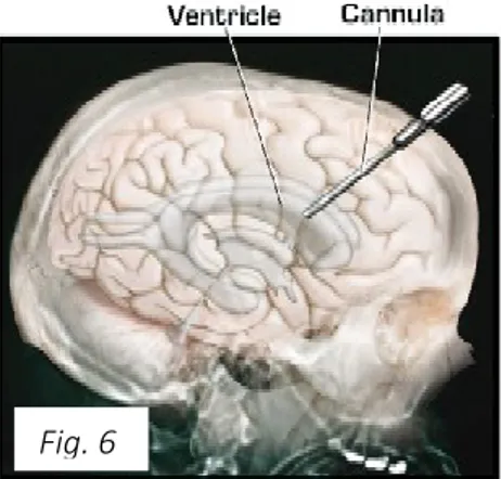 Fig. 8: inserimento del sensore(CODMAN ® ) intraparenchimale dopo minicraniectomia nel lato opposto alla  ciste per il rilevamento della pressione intracranica