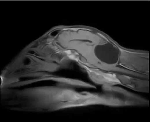 Fig. 7: Ciste nella Fossa Rostrale   Fig. 8: Ciste nella Fossa Caudale 