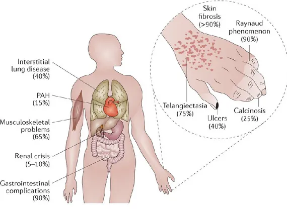 Figure  1.1. Organ  complications  associated  with  systemic  sclerosis. The uncontrolled  fibrosis and scaring of the skin and internal organs in systemic sclerosis leads to severe and  sometimes  life-threatening  complications