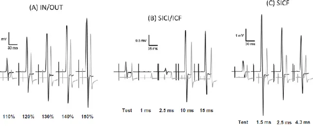 Figura  1:  Potenziali  evocati  motori  in  un  paziente  (linea  nera)  e  in  un  controllo  (linea  grigia).Nel  paziente  si  evidenzia  un  maggiore  MEP  nella  curva  IN-OUT,  una  maggiore  facilitazione in ICF e SICF (Ortu et al., 2013)