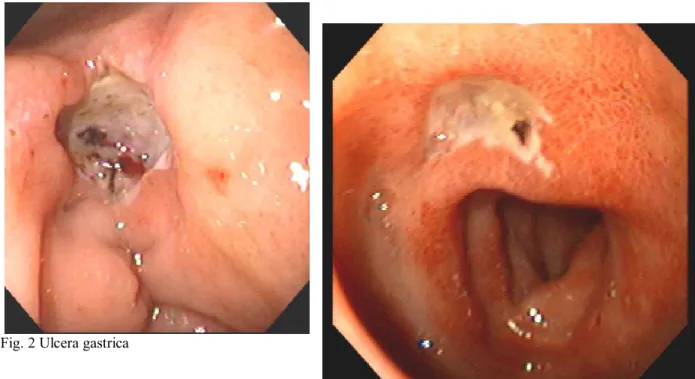 Fig. 2 Ulcera gastrica 