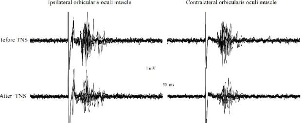 Fig.  1  Blink  reflex  recorded  from  a  representative  subject  before  and  immediately  after  delivery  of  trigeminal  nerve  stimulation