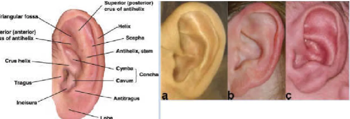 Figura  4:  Sulla  destra  la  descrizione  delle  singole parti  anatomiche  dell’orecchio;  sulla  sinistra  le  varie anomalie dell’antielice (Hunter A