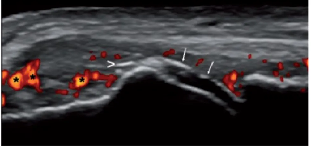 Figura 7: segno del “doppio contorno”,   ipertrofia sinoviale power Doppler positiva. 