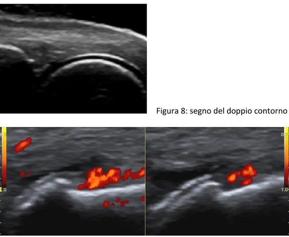 Figura  9:  segno  del  doppio  contorno,  versamento  articolare,  ipertrofia  sinoviale  power  Doppler  positiva 