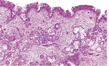 Fig. 1. Mucosa  normale  rinosinusale (H&amp;E, 100x)  ricoperta  da  epitelio di  tipo  respiratorio  su  una  delicata  membrana  basale