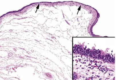 Fig.  3. Polipo  edematoso  eosinofilo(H&amp;E,  20×).  Mostra  ispessimento  della  membrana  basale  e  edema  della  sottomucosa