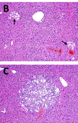 Figura 9. L’iniezione idrodinamica del gene PIK3CA-E545K induce lo sviluppo di lesioni  preneoplastiche nel fegato di topo tre mesi dopo iniezione
