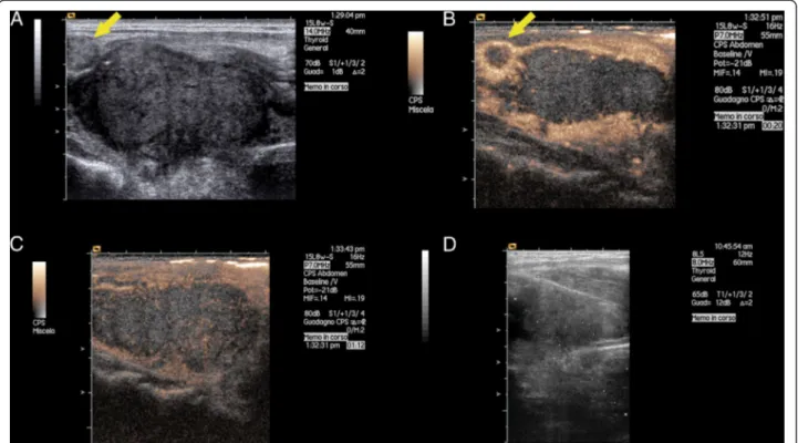Figure 2 Thyroid ultrasound with contrast enhancement and biopsy. Longitudinal view of the right lobe of the thyroid gland performed with linear probe (7.5-14 Mhz) in conventional ultrasound (panel A, D) and after contrast enhancement ultrasound (panel B,C